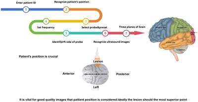 Progress in the application of ultrasound in glioma surgery